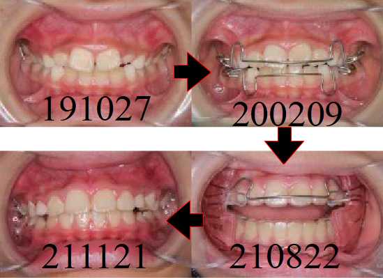 子どものアライナー治療例
