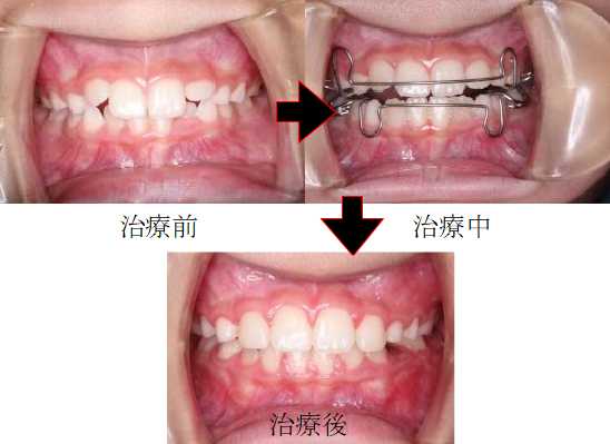 子どもの拡大治療例