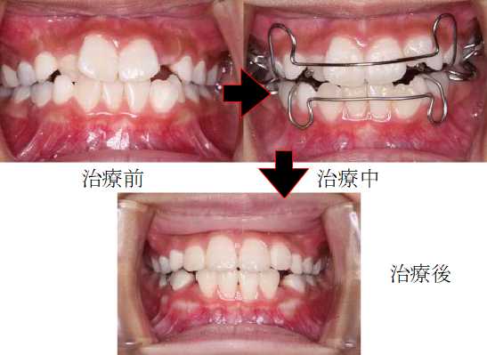 子どもの拡大治療例